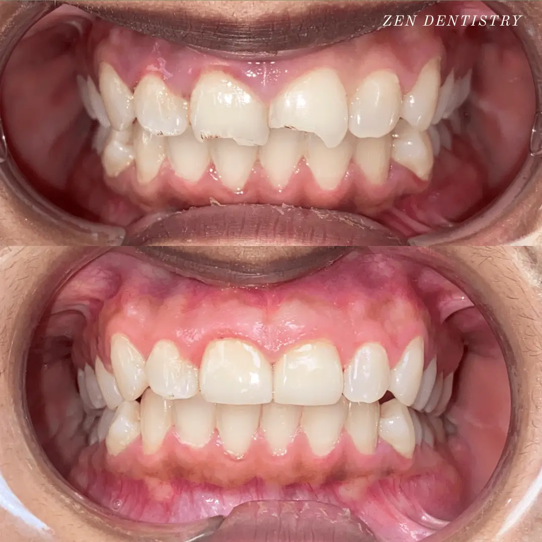 before-after-1.webp