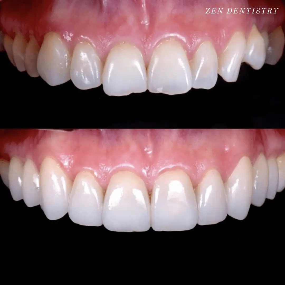 before-after-2.webp