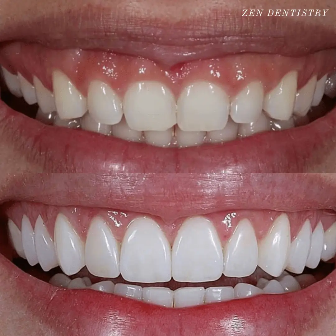 before-after-4.webp