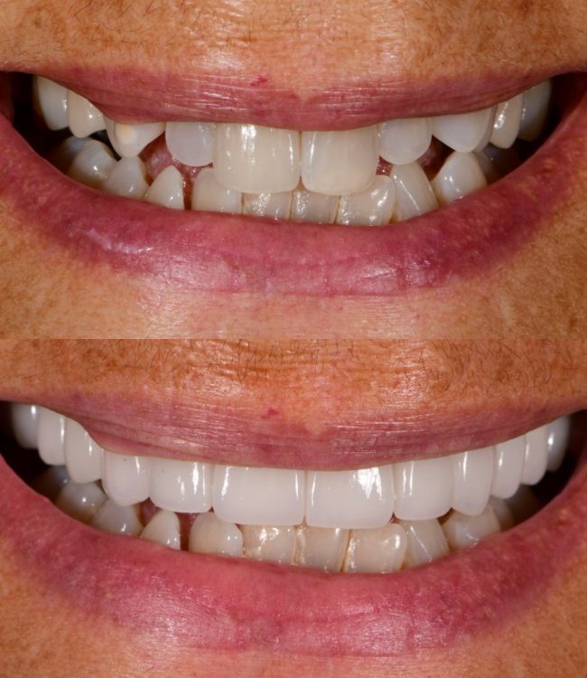 Upper porcelain veneers