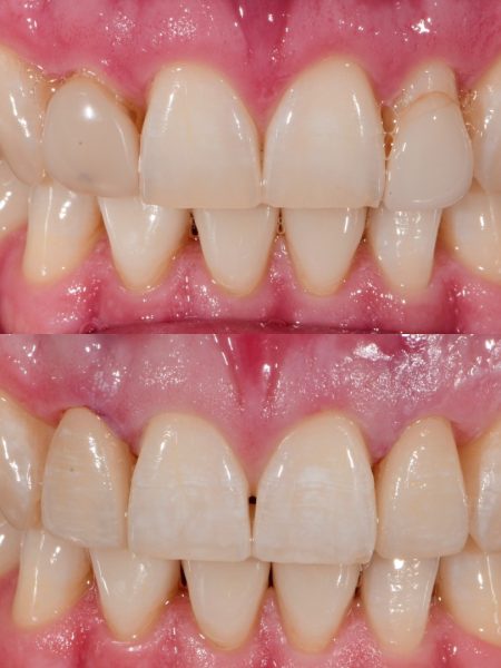 Upper lateral porcelain veneers