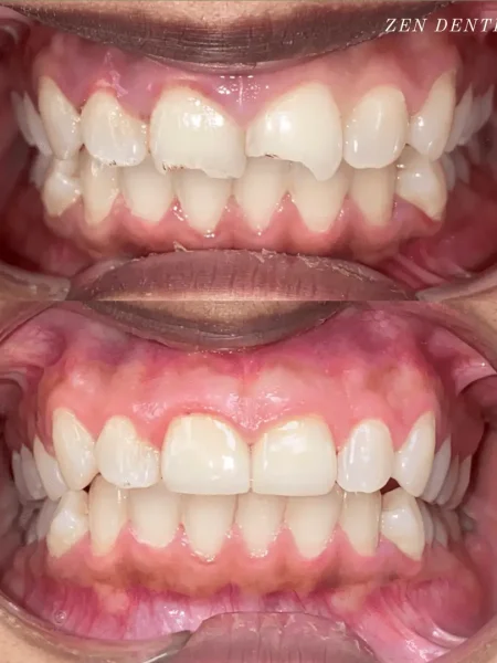 before-after-1.webp