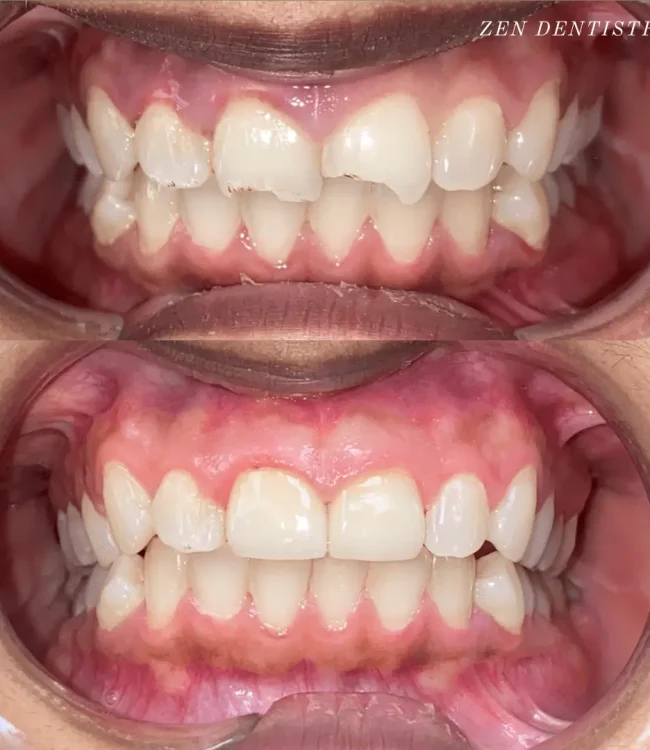 before-after-1.webp