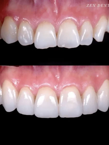 Full mouth rehabilitation with porcelain veneers.