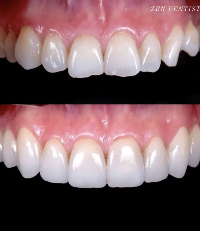 Full mouth rehabilitation with porcelain veneers.