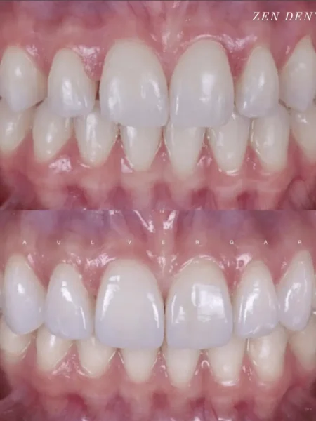 Upper six porcelain veneers