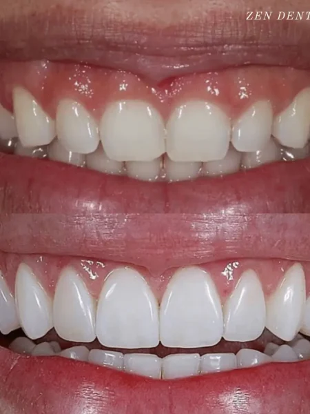 Gum lift with porcelain veneers