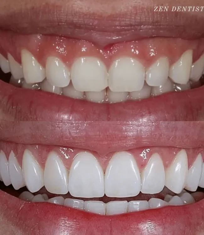 Gum lift with porcelain veneers